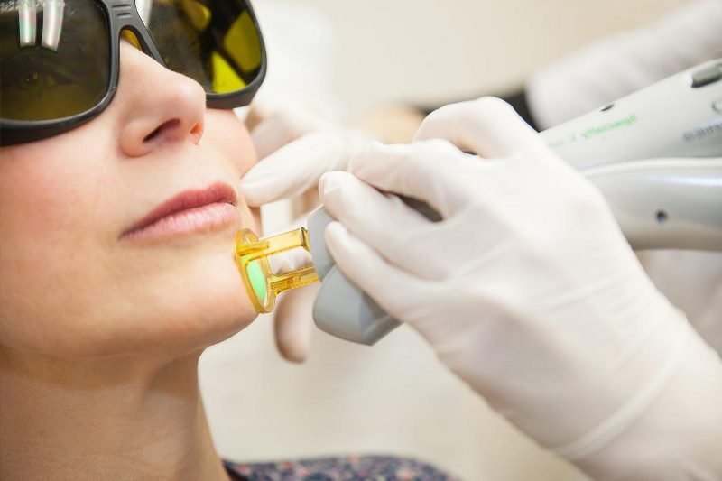 Lazer epilasyonu yaptırırken nelere dikkat edilmeli