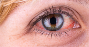 Göz kızarıklığı nasıl geçer