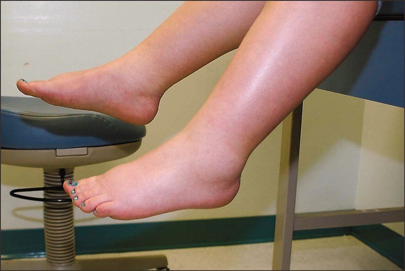 Ödem atmak için ne yapmalı